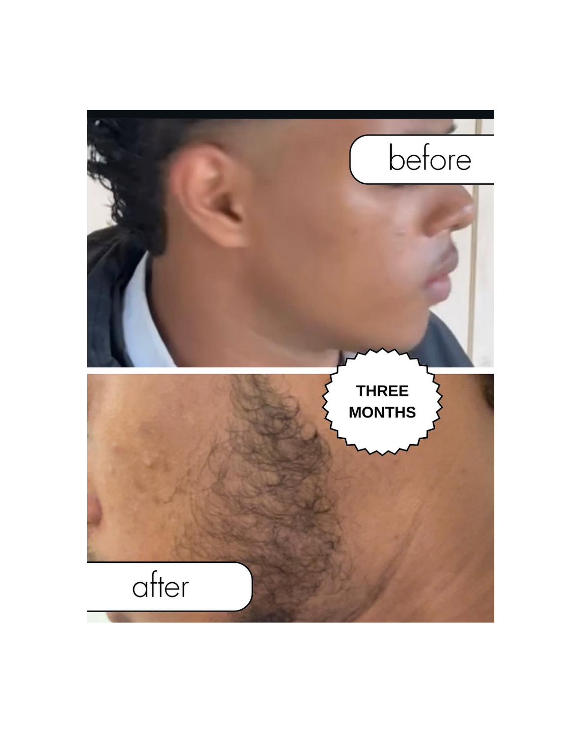Before and after comparison of a person's beard with visible hair growth over three months.